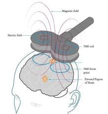 Transcranial Magnetic Stimulation