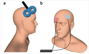 TMS non-invasive magnetic brain stimulation